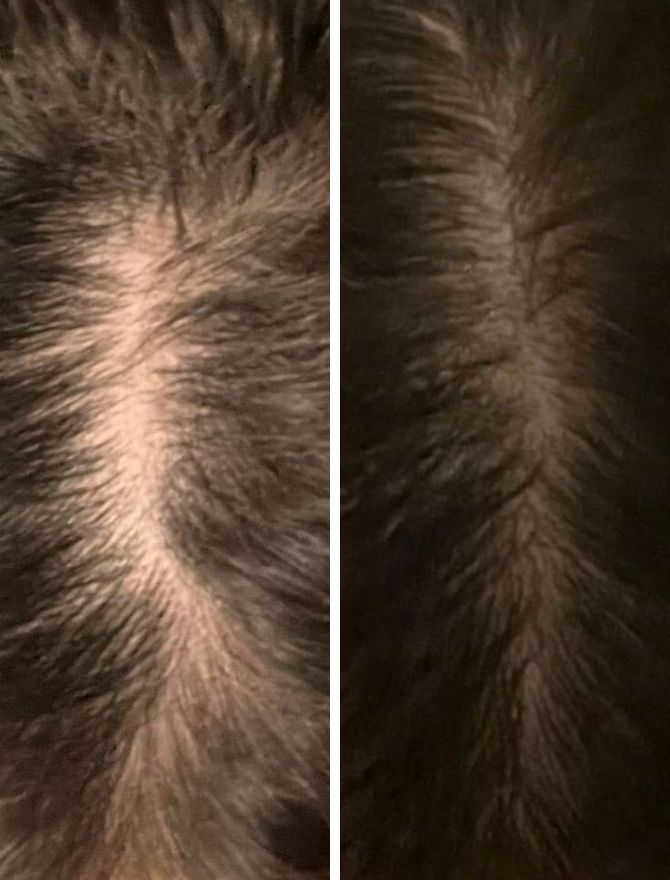 Was sind die Hauptursachen für Haarausfall bei Frauen? Alles, was Sie wissen müssen