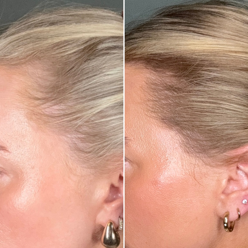 Was sind die Hauptursachen für Haarausfall bei Frauen – und ist er umkehrbar?