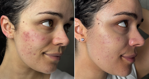 Rotlichttherapie Vorher & Nachher: Bilder und Ergebnisse