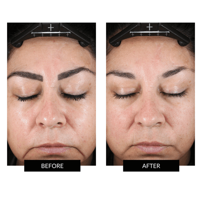 NuFACE TRINITY+ Toning Device and Wrinkle Reducer Attachment