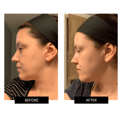 NuFACE TRINITY+ Toning Device and Wrinkle Reducer Attachment