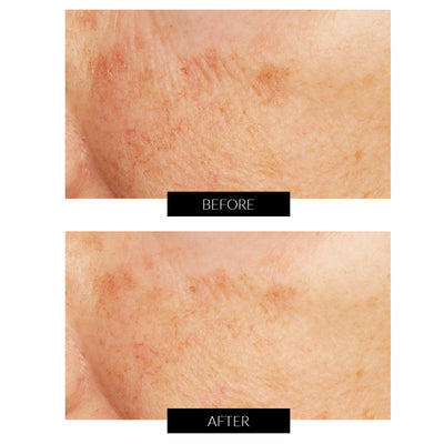 Caviar Lime Acid Peel with Glycolic Acid (50ml)
