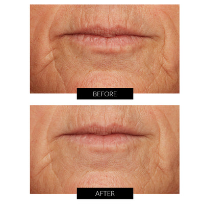 Lancer Skincare Pro Polish Microdermabrasion Device