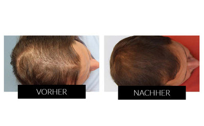 Vorher Nachher 