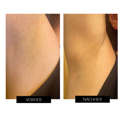 SmoothSkin Pure Mini IPL Gerät - Vorher Nachher 2