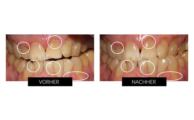 Silk'n Toothwave Elektrische Zahnbürste