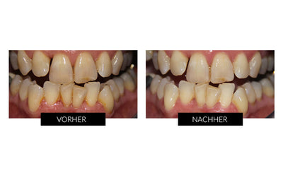 Silk'n Toothwave Elektrische Zahnbürste