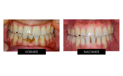 Silk'n Toothwave Elektrische Zahnbürste
