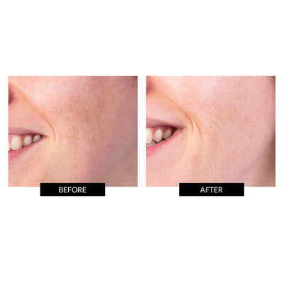 TriPollar STOP V + Gel
