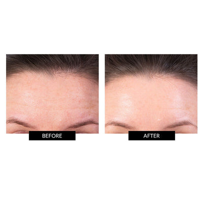 TriPollar STOP V + Gel